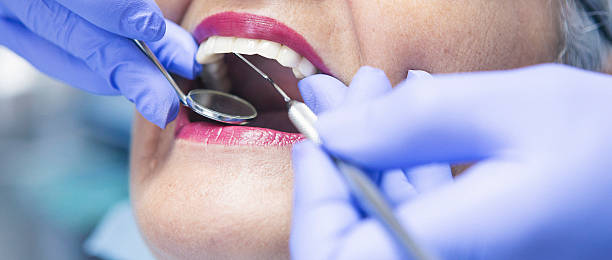 Best Emergency Wisdom Teeth Removal in Manhattan Beach, CA